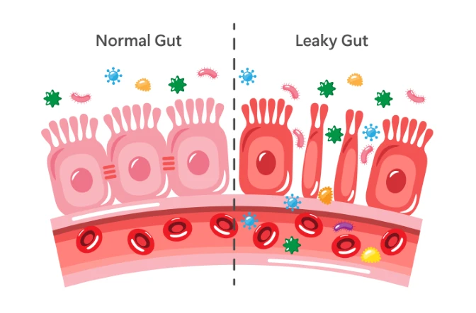 Leaky Gut Syndrome Explained: Symptoms, Causes, and Management Tips